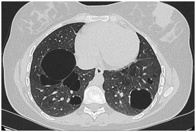 Alpha-1 antitripsyn deficiency and augmentation therapy in pregnancy: two case reports
